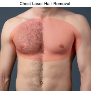 Full Chest - Laser Hair Removal for Women – Hyaface