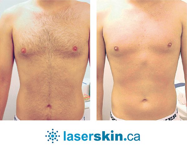 Everything You Need To Know About Laser Hair Removal Service