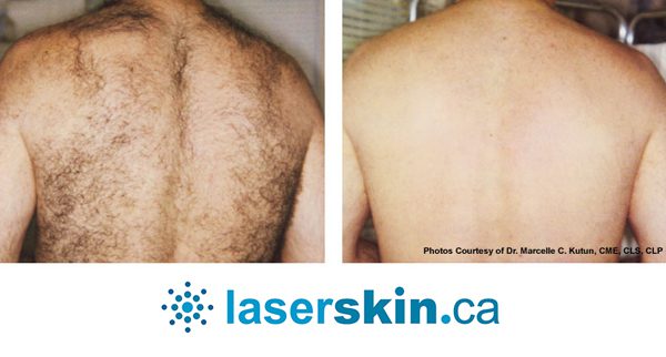 IPL Laser Hair Removal  Laser vs IPL Hair Removal  solutions  Services  and Products