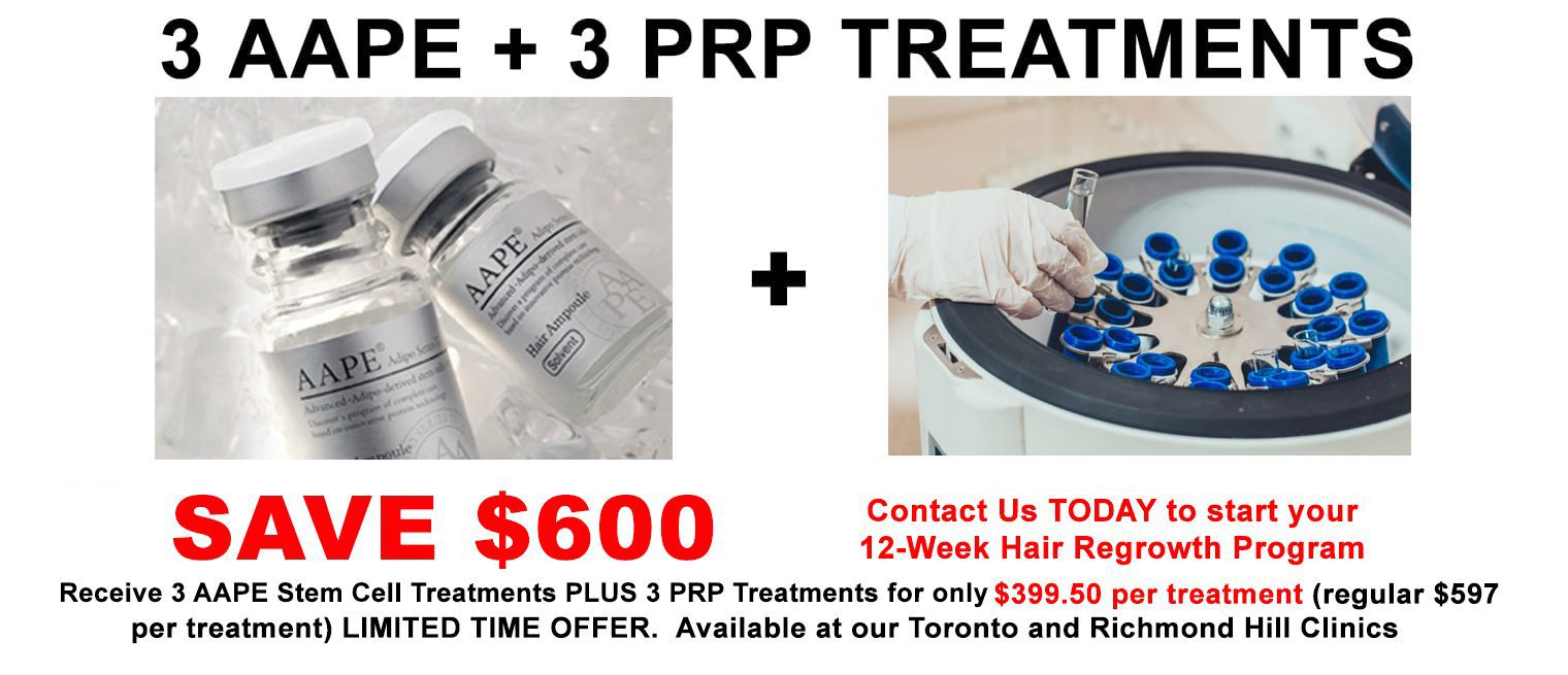 AAPE and PRP Hair Loss
