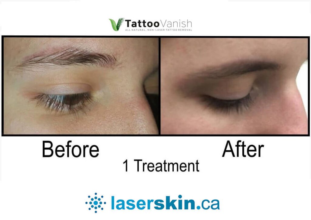 Before and After Tattoo Removal - Get the Best Res (10)