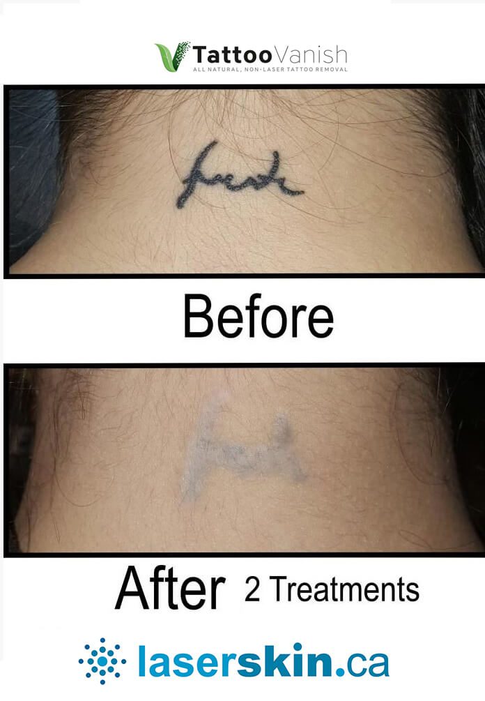 Vanish Laser Tattoo Removal and Skin Aesthetics  702 Eureka Street   Weatherford  Fresha