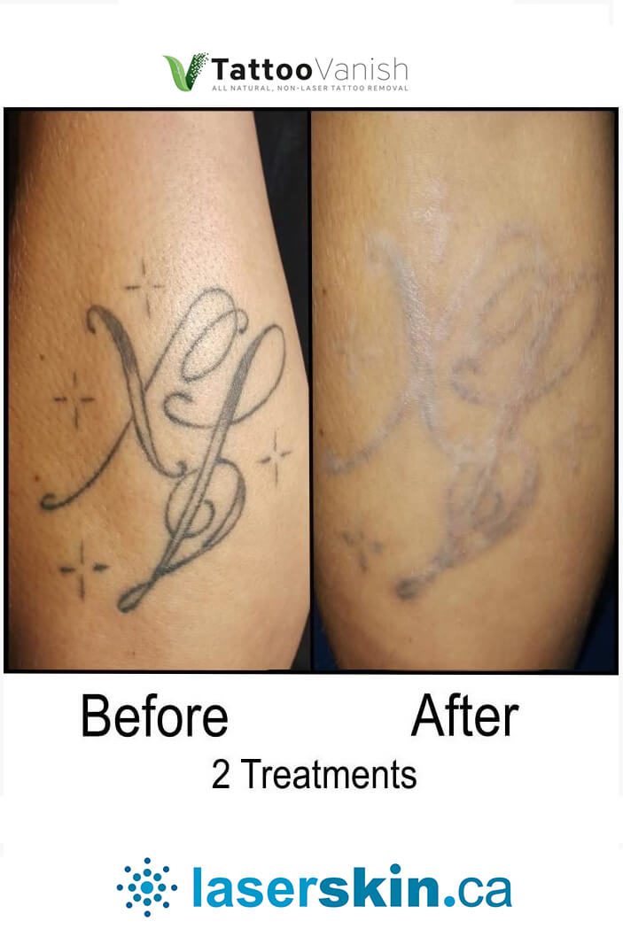 Tattoo Removal Before and After ❤️ SAVE $197 TATTOOREGRET.CA