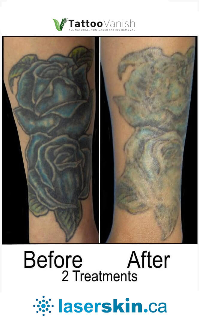 Before and After Tattoo Removal - Get the Best Res (14)