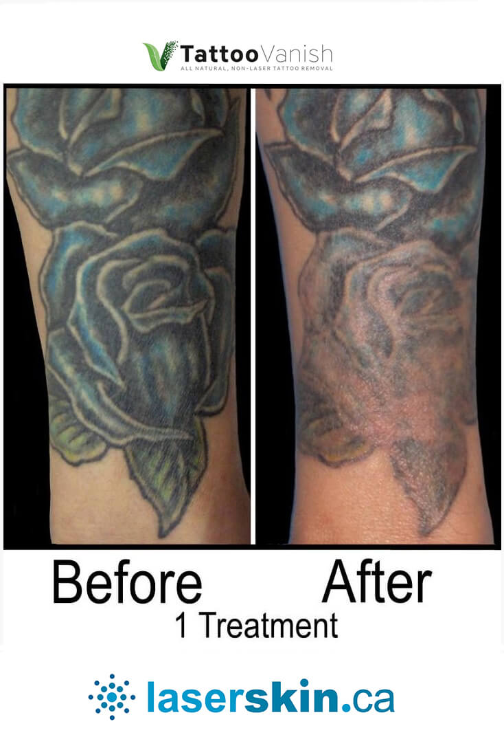 PicoSure Tattoo Removal Before and After Photos - Orange Coast Aesthetics