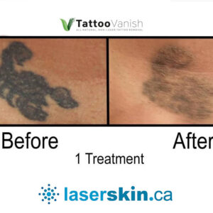 Before and After Tattoo Removal - Get the Best Res (16)