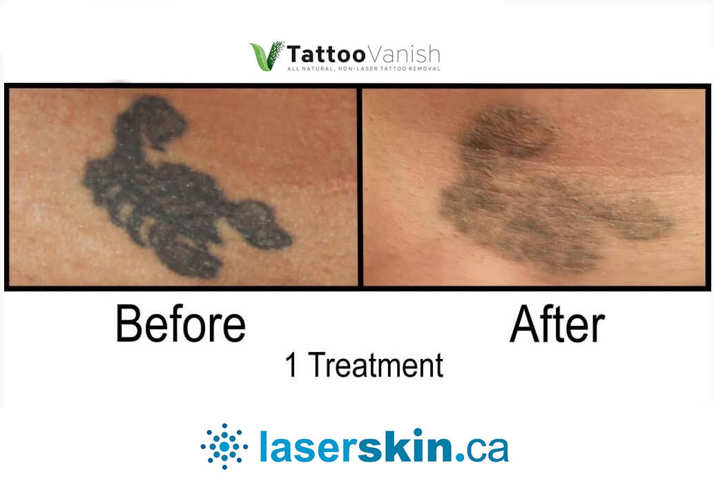 Before and After Tattoo Removal - Get the Best Res (16)