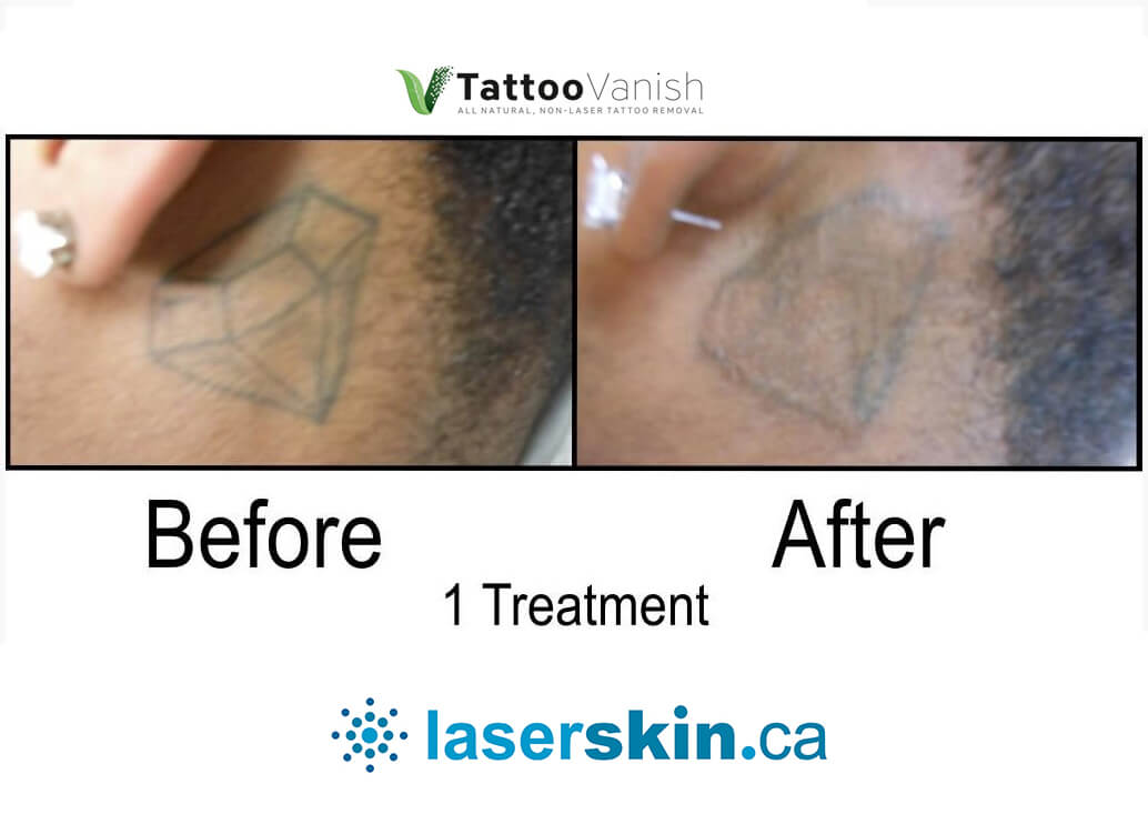 Before and After Tattoo Removal - Get the Best Res (17)