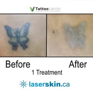 Before and After Tattoo Removal - Get the Best Res (18)
