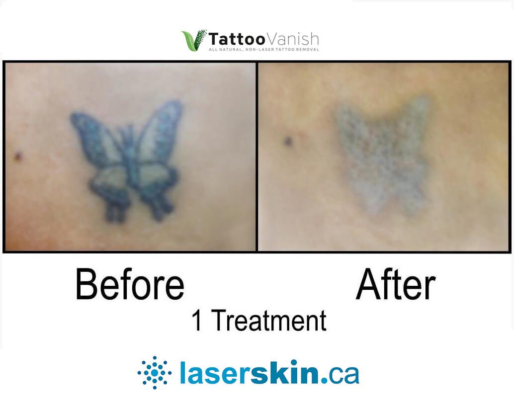 Before and After Tattoo Removal - Get the Best Res (18)
