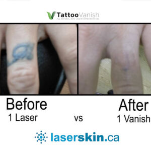 Before and After Tattoo Removal - Get the Best Res (19)