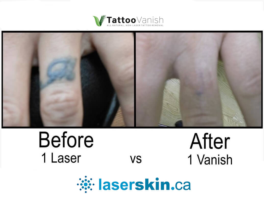 Laser Tattoo Removal Gallery | Nazarian Plastic Surgery