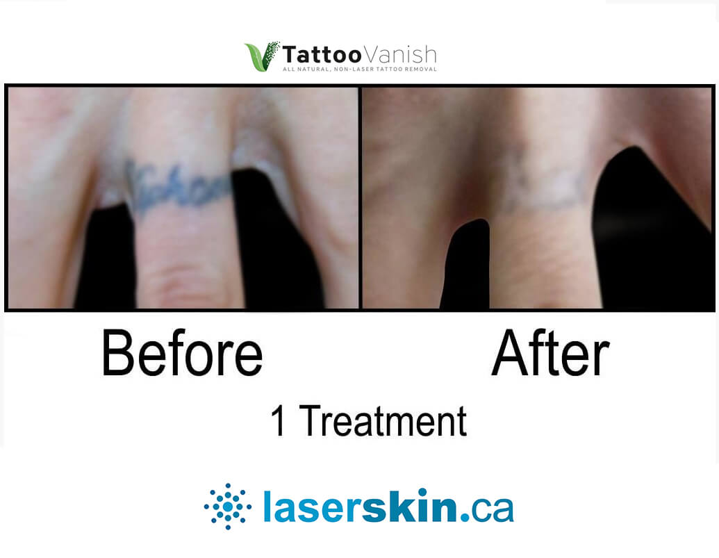 Before and After Tattoo Removal - Get the Best Res (20)