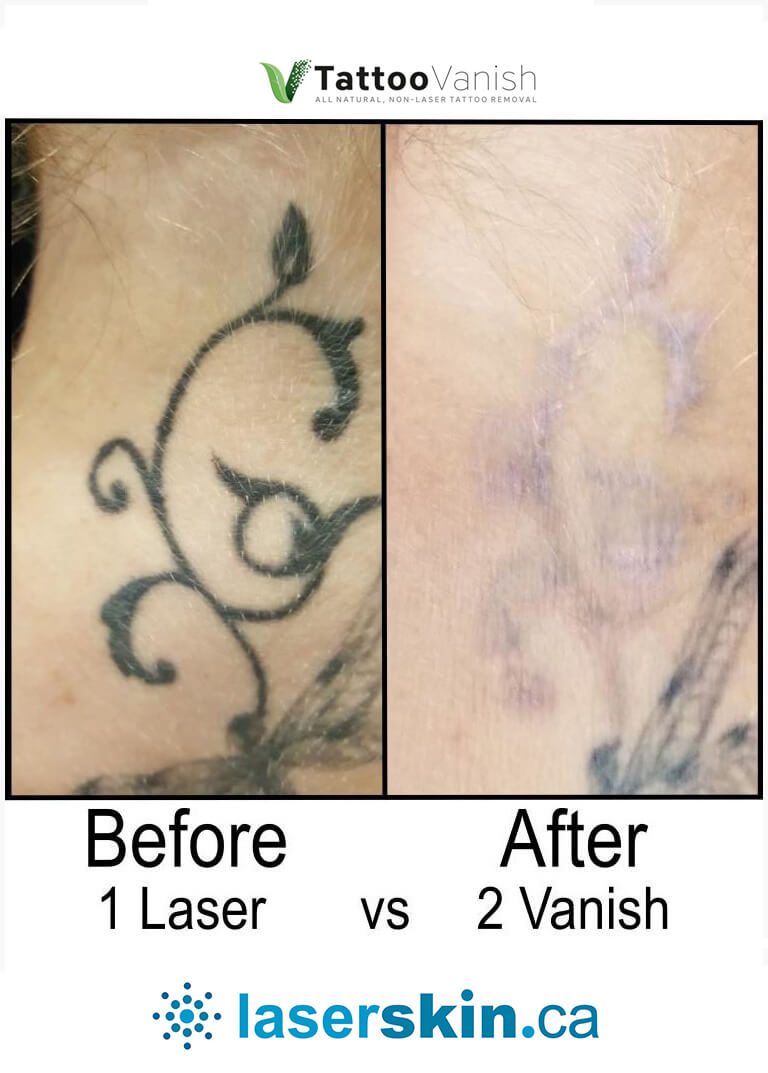 Before and After Tattoo Removal - Get the Best Res (21)