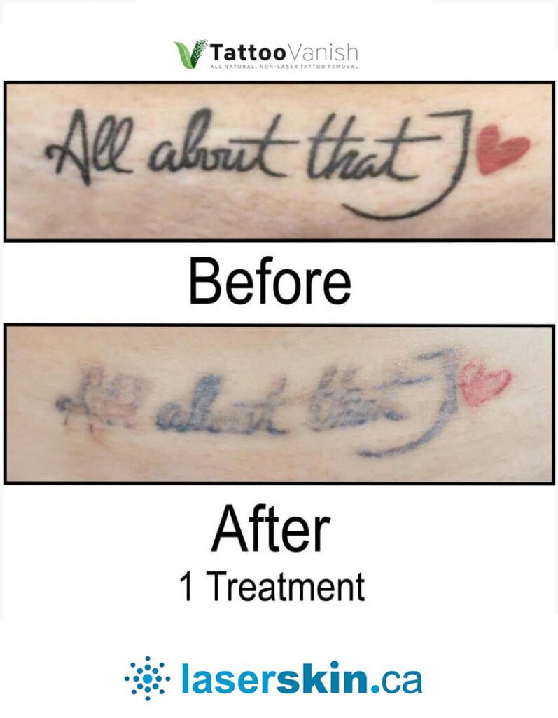 Before and After Tattoo Removal - Get the Best Res (22)
