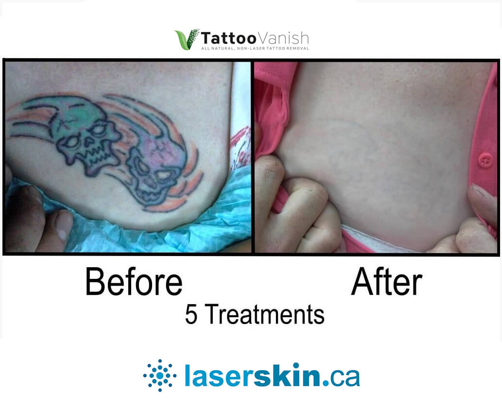 Before and After Tattoo Removal - Get the Best Res (23)