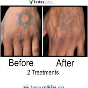 Before and After Tattoo Removal - Get the Best Res (24)