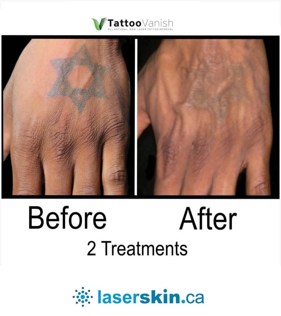 Before and After Tattoo Removal - Get the Best Res (24)