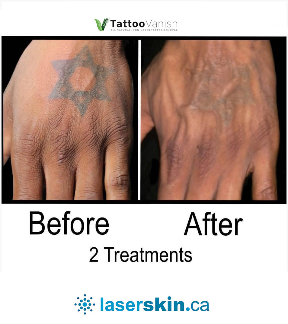 TATTOO VANISH  Paramedical Tattoo