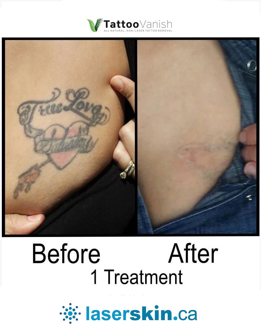 Before and After Tattoo Removal - Get the Best Res (25)