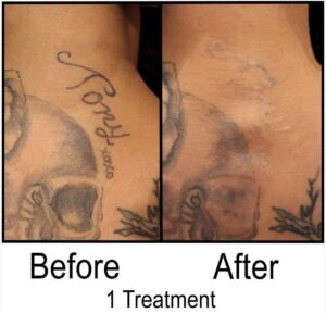 Before and After Tattoo Removal - Get the Best Res (26)