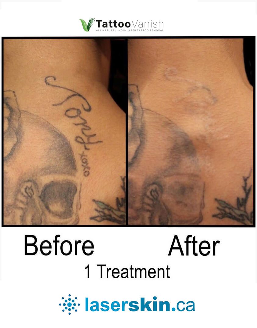 Before and After Tattoo Removal - Get the Best Res (26)