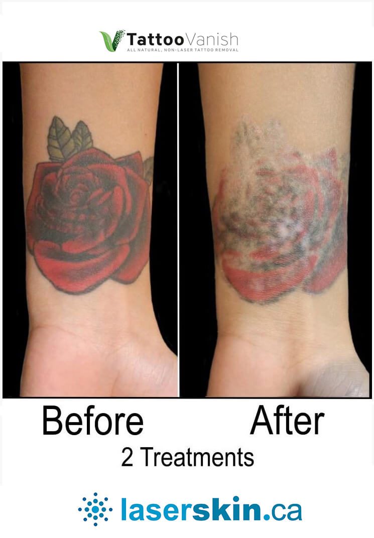 Before and After Tattoo Removal - Get the Best Res (27)