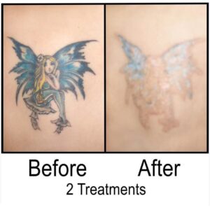 Before and After Tattoo Removal - Get the Best Res (28)