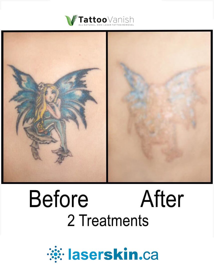 Before and After Tattoo Removal - Get the Best Res (28)