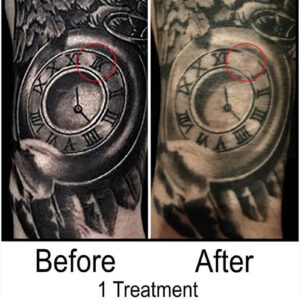 Before and After Tattoo Removal - Get the Best Res (29)