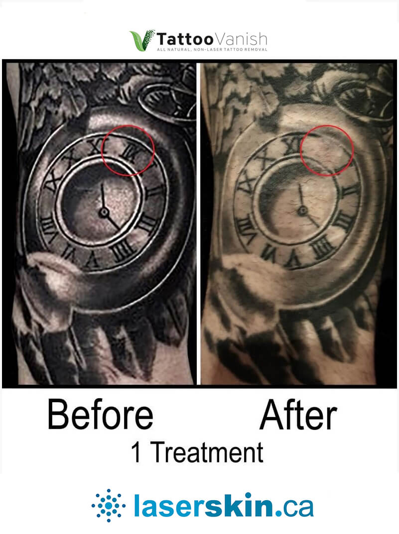 Before and After Tattoo Removal - Get the Best Res (29)