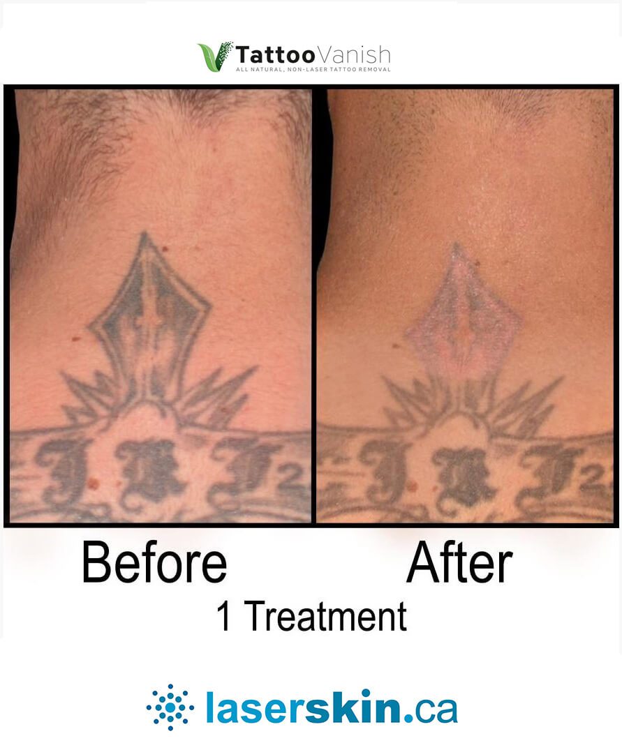 Before and After Tattoo Removal - Get the Best Res (30)