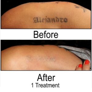Before and After Tattoo Removal - Get the Best Res (32)