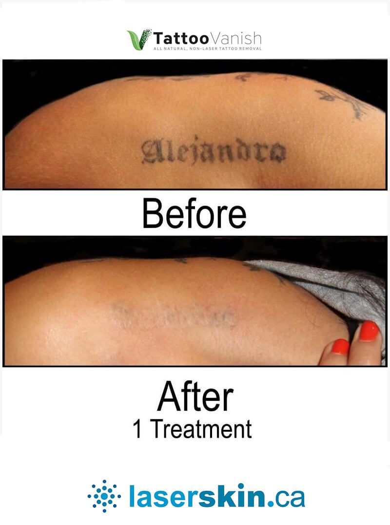 Can you get rid of face tattoos with laser tattoo removal?