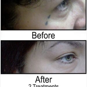 Before and After Tattoo Removal - Get the Best Res (33)