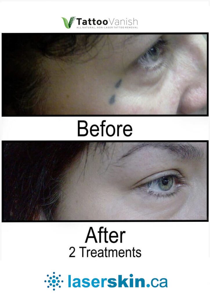 Before and After Tattoo Removal - Get the Best Res (33)