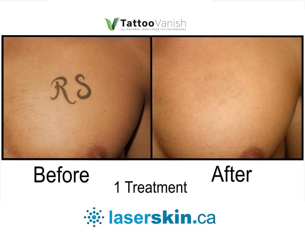 The Healing Process: What To Expect After Tattoo Removal In NYC