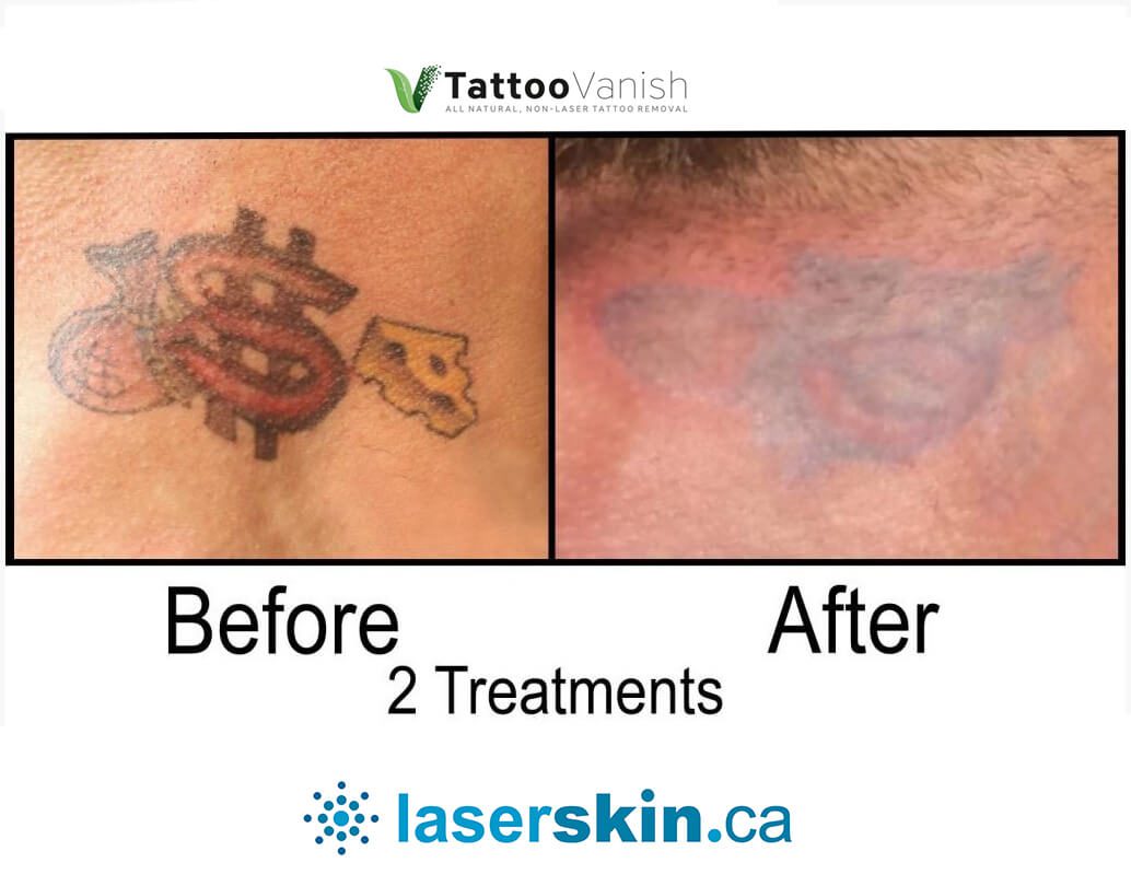 Before and After Tattoo Removal - Get the Best Res (35)