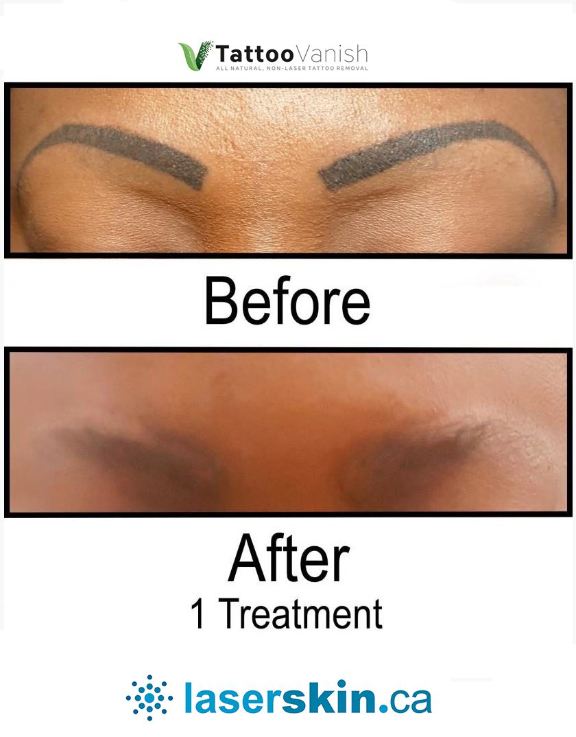 eyebrow removal with Tattoo Vanish