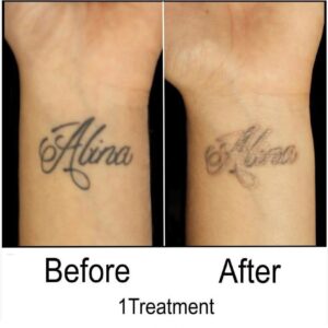 Before and After Tattoo Removal - Get the Best Res (37)