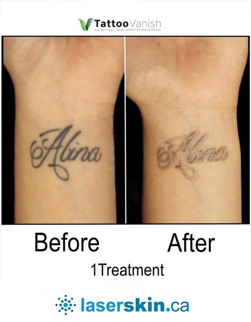 Before and After Tattoo Removal - Get the Best Res (37)