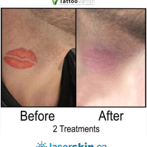 Before and After Tattoo Removal - Get the Best Res (38)