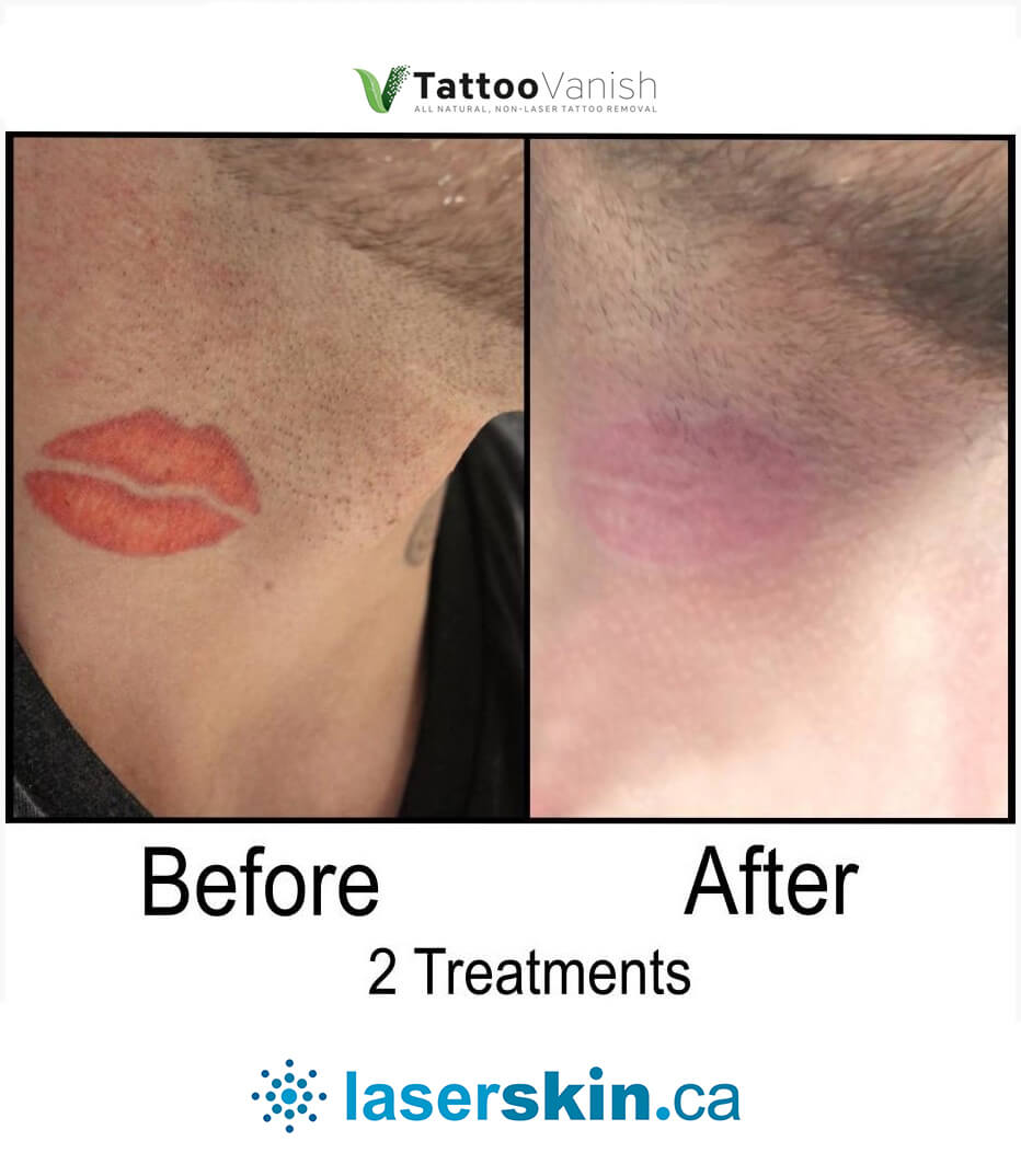 Before and After Tattoo Removal - Get the Best Res (38)