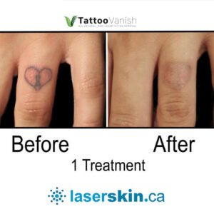 Before and After Tattoo Removal - Get the Best Res (39)