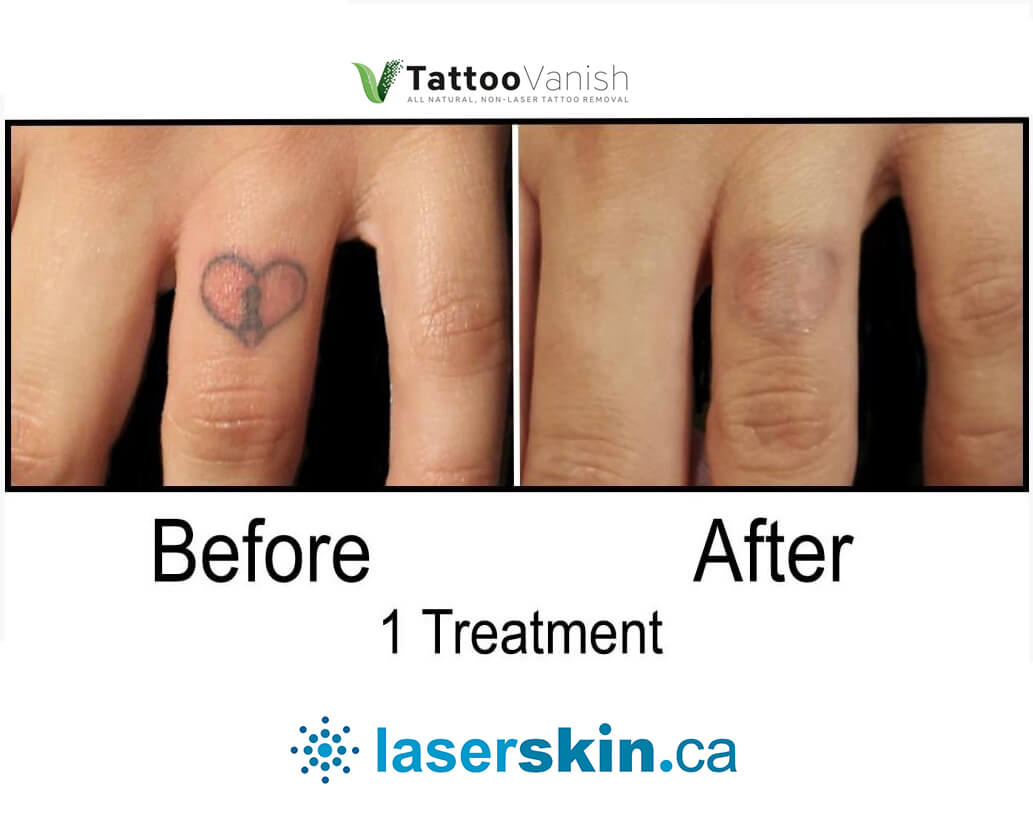 Laser Tattoo removal — Hillside Tattoo Studio