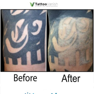 Before and After Tattoo Removal - Get the Best Res (40)