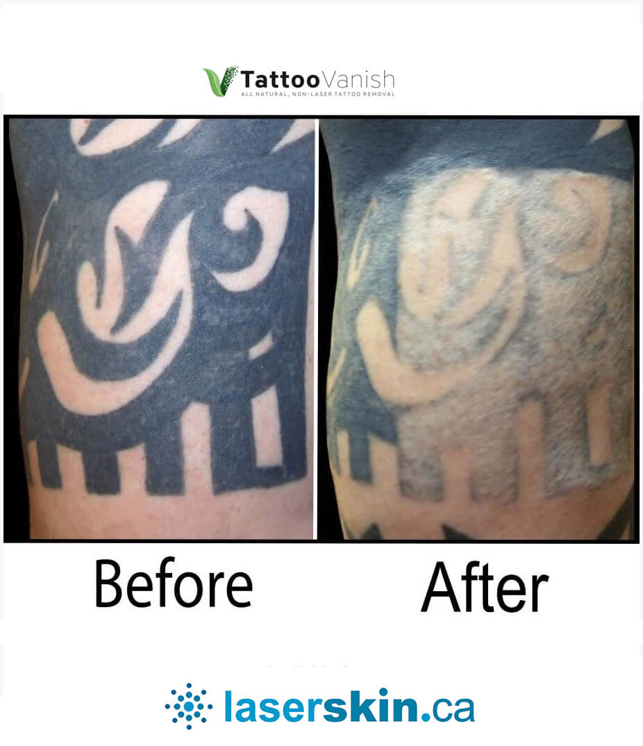 Before and After Tattoo Removal - Get the Best Res (40)