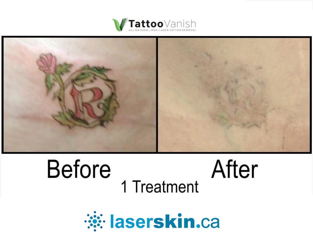 Before and After Tattoo Removal - Get the Best Res (41)