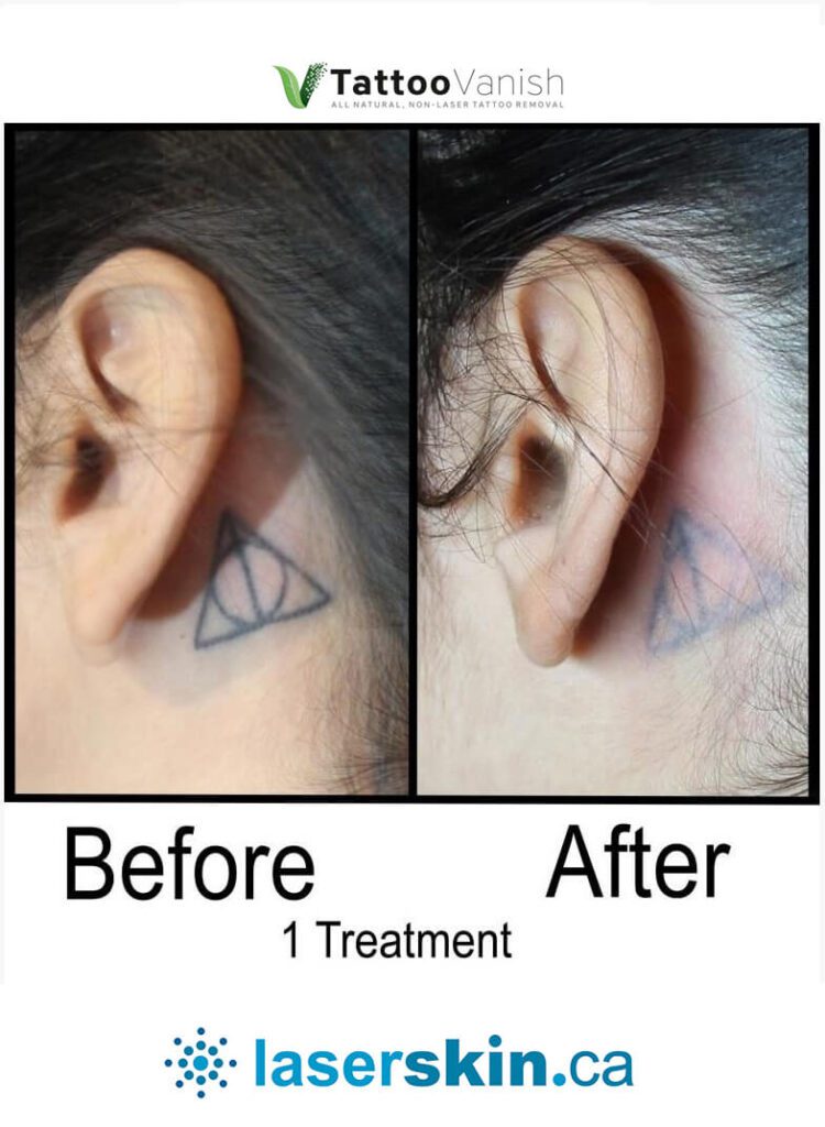 Before and After Tattoo Removal - Get the Best Res (43)