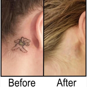 Before and After Tattoo Removal - Get the Best Res (8)